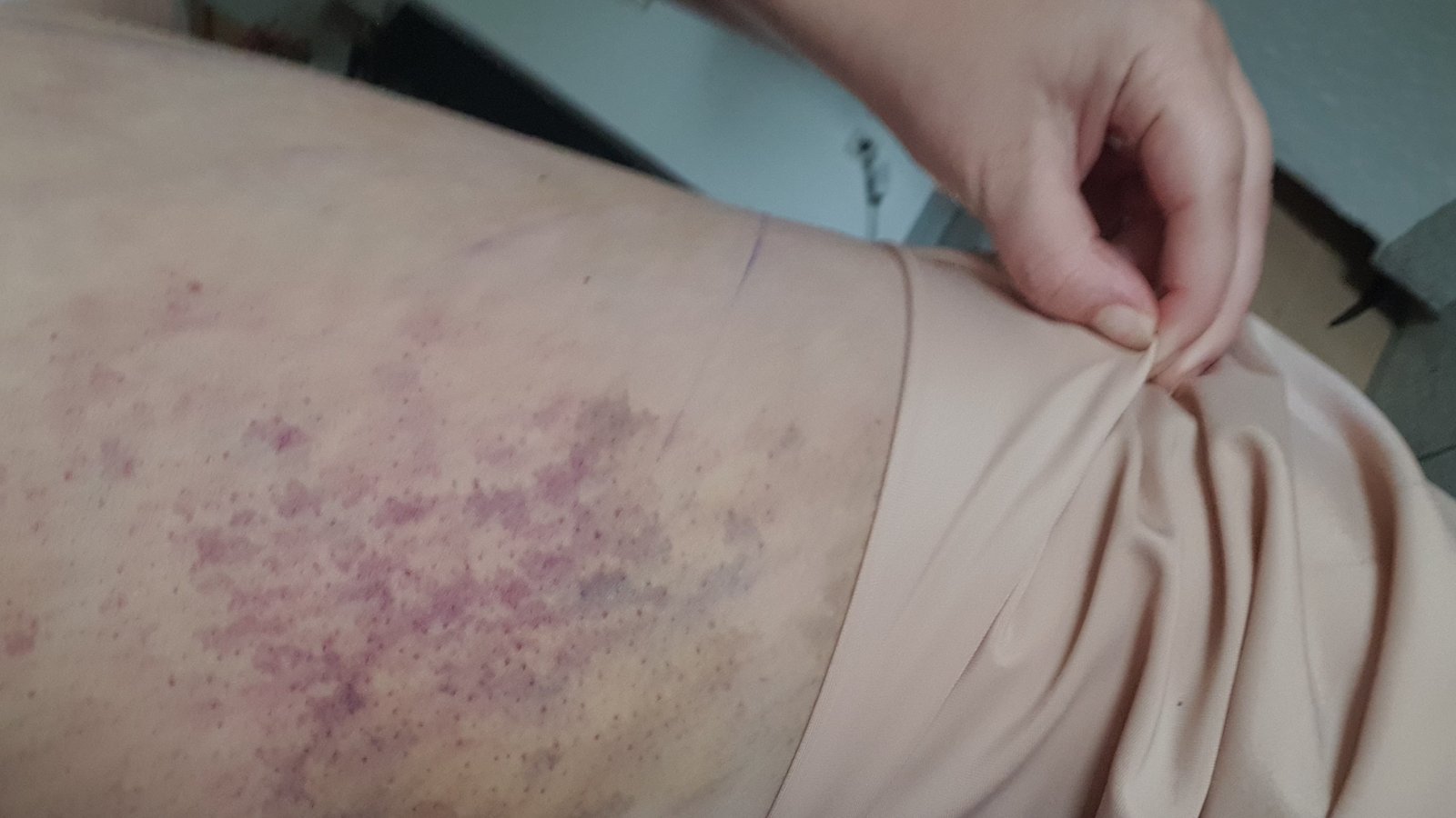Sehr schmerzhafte blaue Flecken ohne ersichtlichen Grund plagen die Erkrankten. Fotos: p Sehr schmerzhafte blaue Flecken ohne ersichtlichen Grund plagen die Erkrankten. Fotos: p